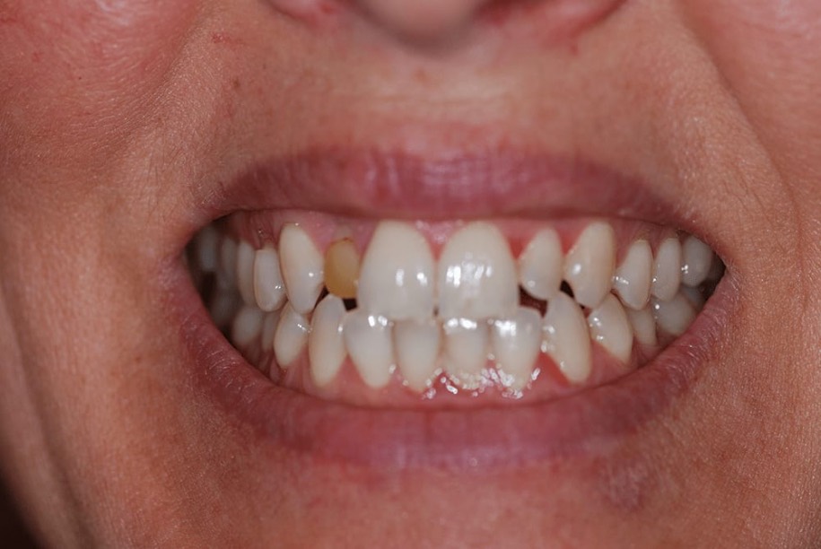 Teeth whitening before, Wellington patient at Thorndon Dental