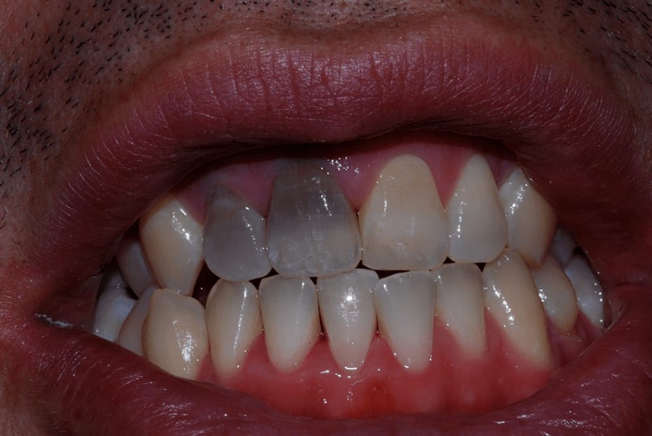 Teeth whitening before, Wellington patient at Thorndon Dental