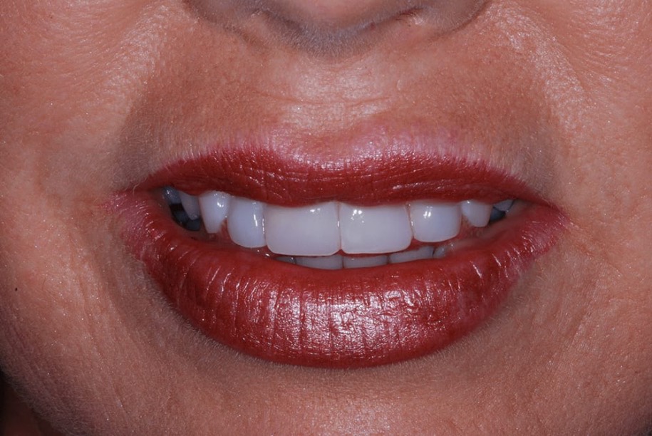 Composite veneers closing a front gap, Thorndon Dental patient