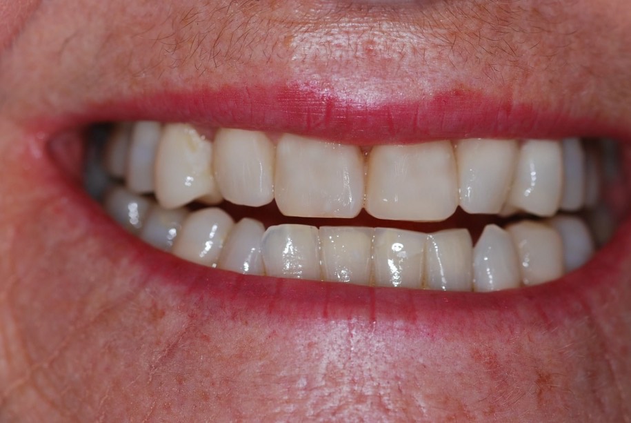 Composite veneers after, Wellington patient at Thorndon Dental