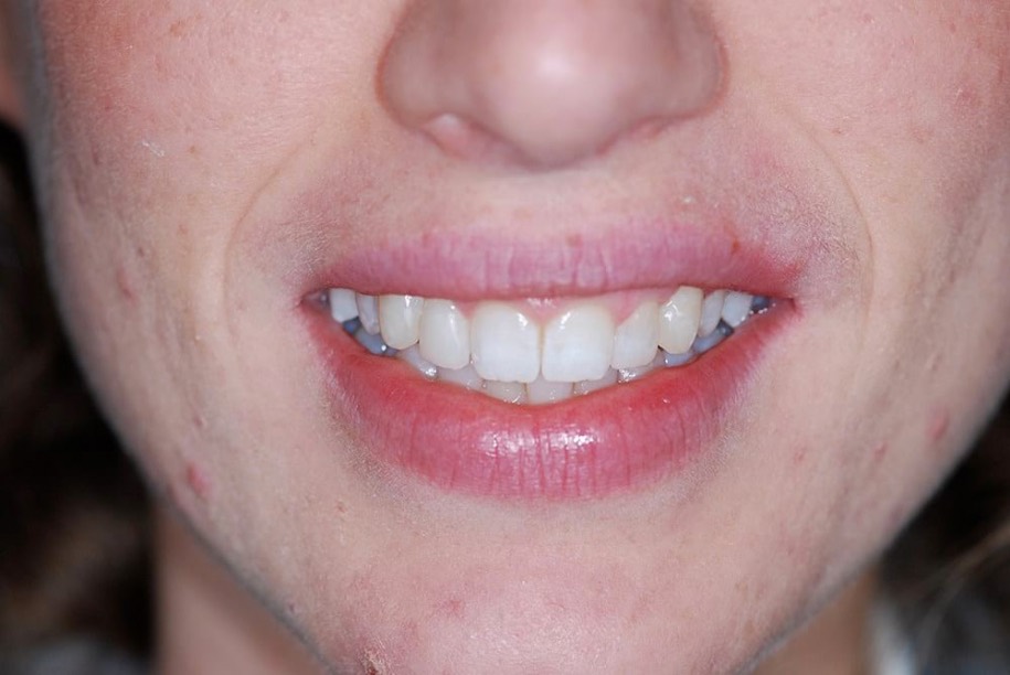 Composite veneers after, Wellington patient at Thorndon Dental