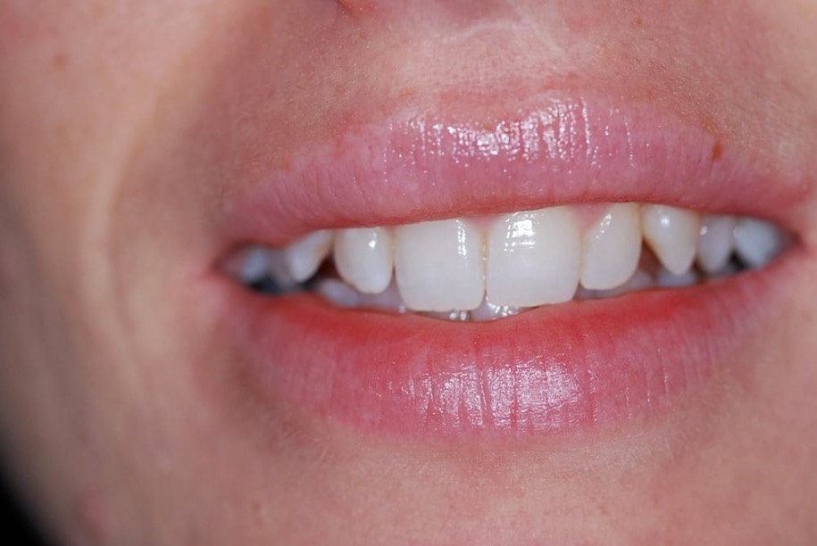Composite veneers before, Wellington patient at Thorndon Dental