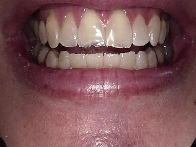 Composite veneers before, Wellington patient at Thorndon Dental