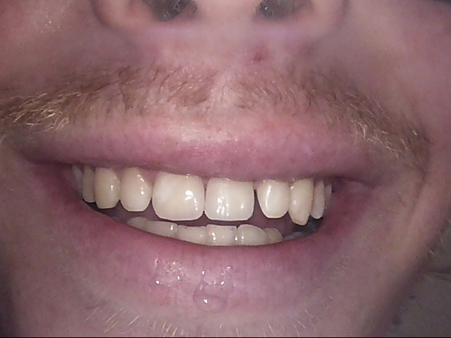 Composite veneers after, Wellington patient at Thorndon Dental