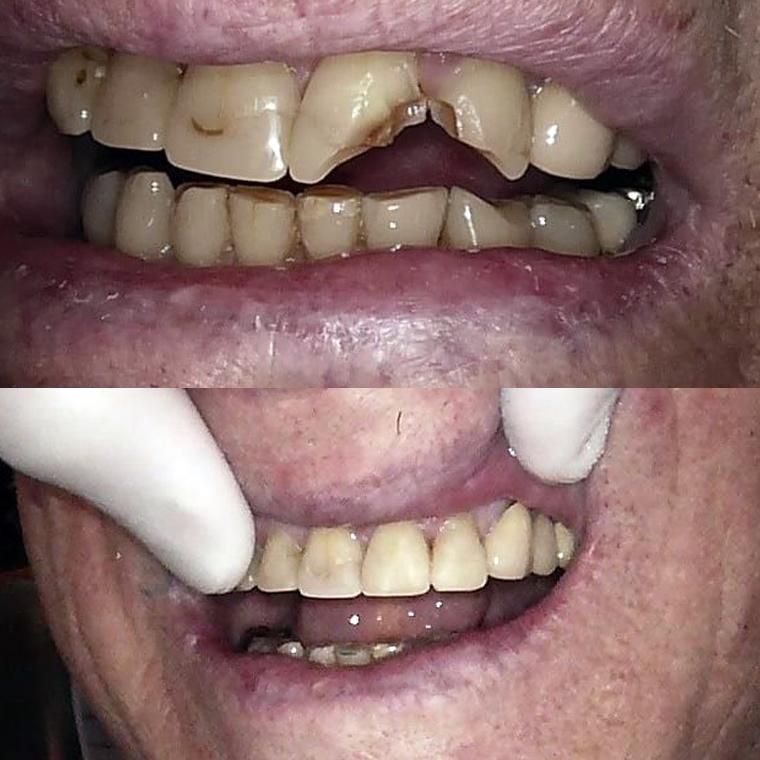 Before and after a dental crown on a Thorndon Dental patient