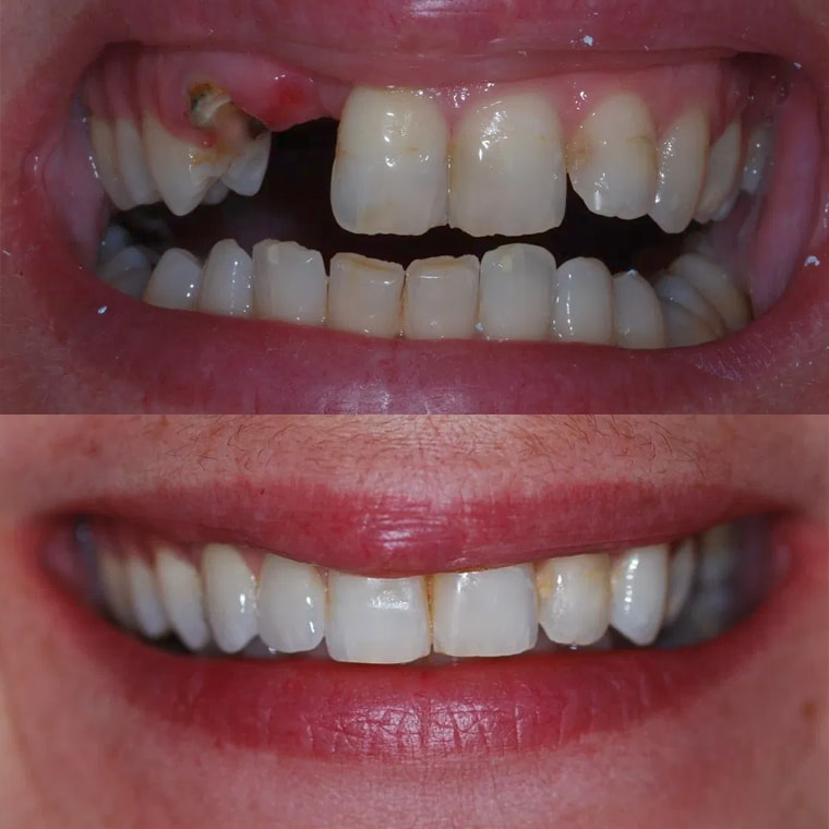 Before and after dental implant treatment at Thorndon Dental, Wellington