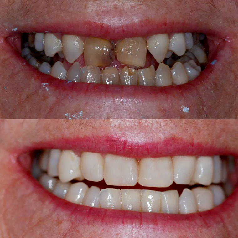 Before and after porcelain veneers on a Thorndon Dental patient